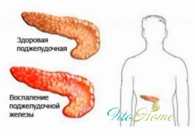 Больная и здоровая железы наглядное пособие по поджелудочной железе