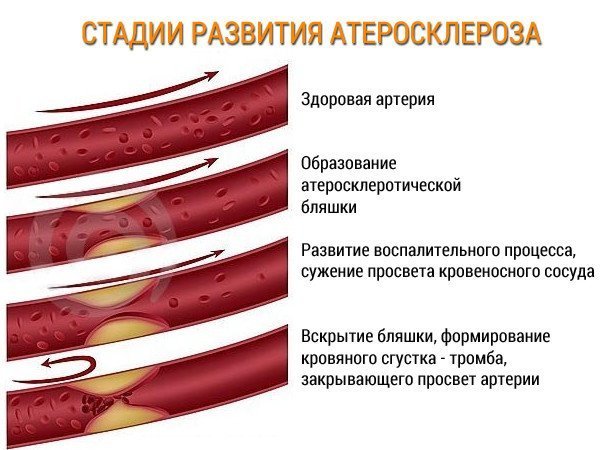 Какие таблетки лучшие от холестерина в крови