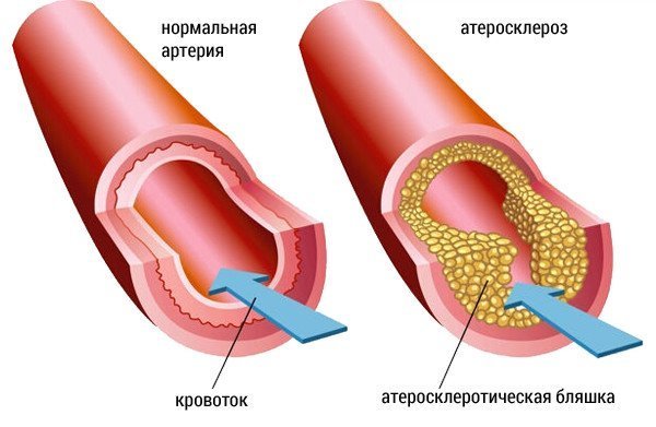 повышен холестерин глюкоза в крови повышен холестерин глюкоза в крови