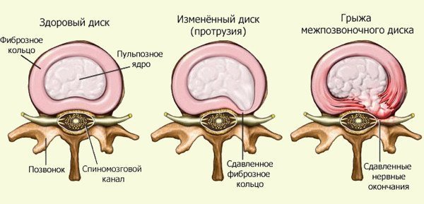 Как выглядит грыжа шейного отдела Как выглядит грыжа шейного отдела