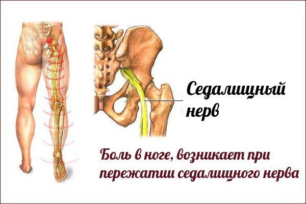 Защемление нерва плечевого сустава позвоночника. Боль в шее, симптомы защемления нервов в шее, радикулита, травмы. Защемление шейного нерва: симптомы и лечение | ПОЗВОНОЧНИК СПИНЫ И ШЕИ. Защемление грыжи позвоночника симптомы и лечение