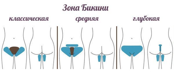 Как удалить папилломы на интимных местах в домашних условиях