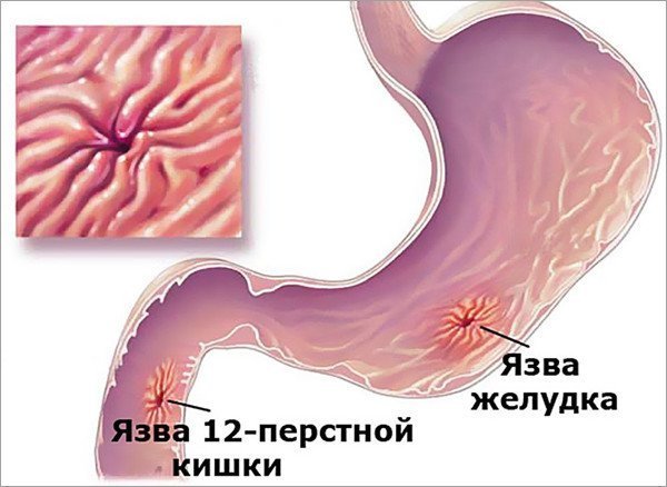 Пептиды при лечении рака