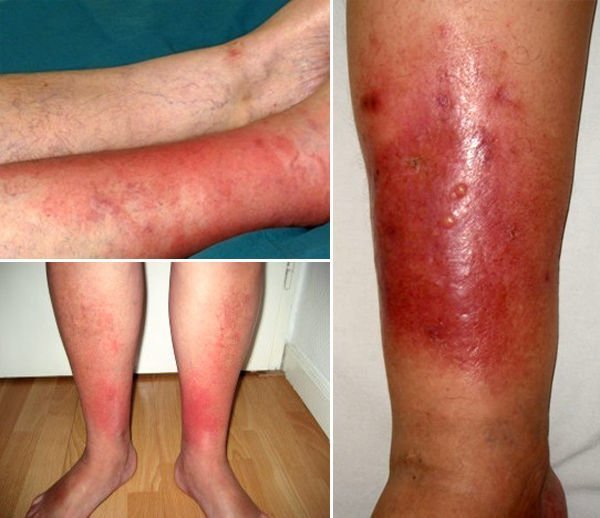 Рожистое воспаление ноги симптомы - как лечить рожистое воспаление ...