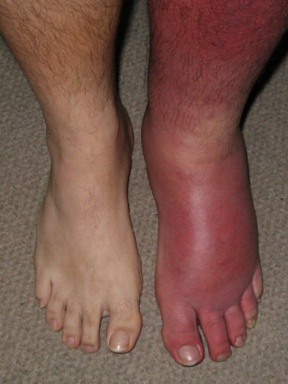 Рожистое воспаление ноги симптомы - как лечить рожистое воспаление ...