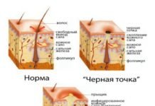 помогает ли полисорб от паразитов помогает ли полисорб от паразитов