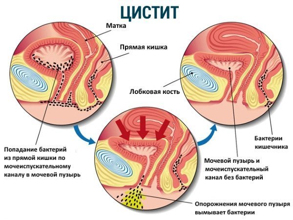 Лечение цистита в домашних условиях народными средствами