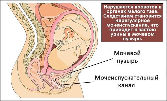 Цистит у беременных