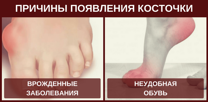 Причины появления косточки на ноге