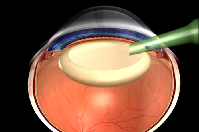 Лечение катаракты ультразвуком