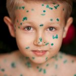 Ветрянка у детей: симптомы и лечение