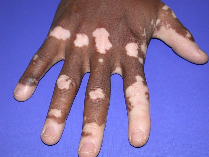 Заболевания с обесцвечиванием кожи