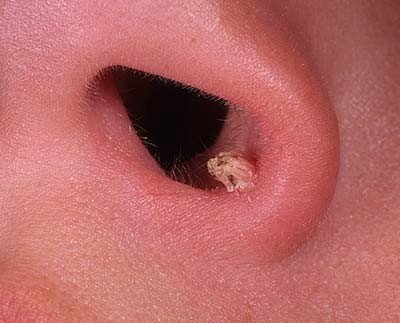 Папиллома в носу лечение в домашних условиях