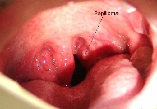 Во рту папилломы - лечение папилломы на слизистой рта