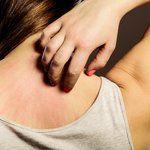 Мази и крема от псориаза