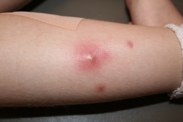Инфекционные и бактериальные высыпания на ногах