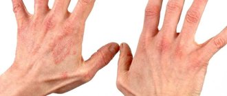 Как лечить псориаз на руках?