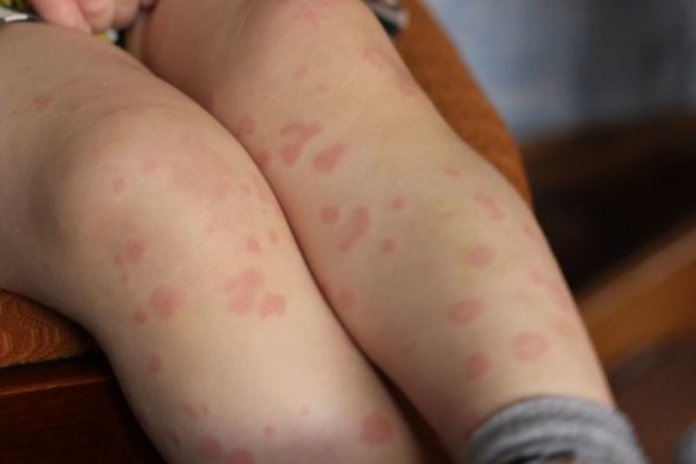 Красные пятна на ногах при аллергии