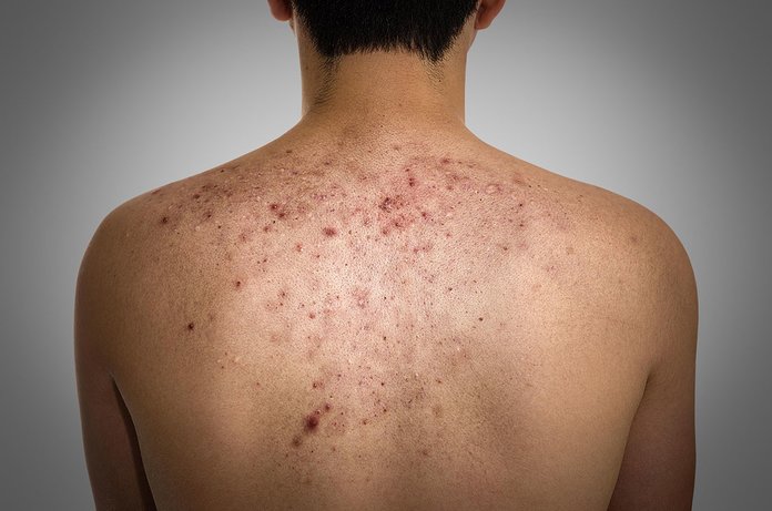 Сыпь на спине при аллергии